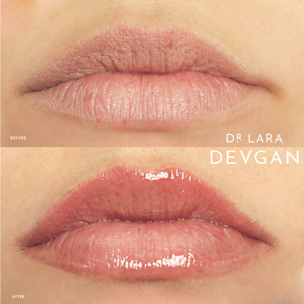 Dr. Lara Devgan Platinum Lip Plump